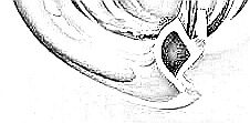 Snake and Pig Basilisk goggle uses a pillow style gasket that seals well, but minimizes suction around the eyes